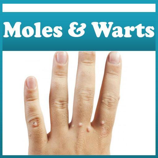 Moles and Warts Removal